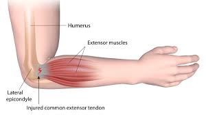 The tendons of extensor muscles help stabilize the hand during forced graping and provide the loosness needed for sensitive finger movements independent from each other. Physiotherapy For Elbow And Forearm Pain Glebe Physio