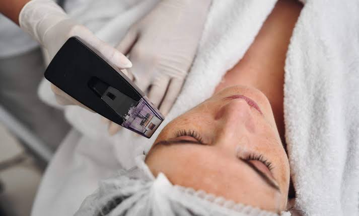 Understanding the Morpheus8 Results Timeline - London Premier Laser & Skin  Clinic
