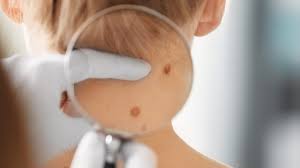 If you aren't sure which type of skin cancer. 6 Significant Breakthroughs In Skin Cancer Research Israel21c