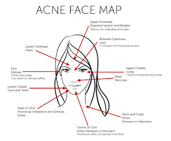 Acne Face Map What Acne Revealing About Your Health
