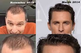 A clinician diagnoses female pattern hair loss by taking a medical history and examining the scalp. Matthew Mcconaughey Hair Loss Secrets Revealed