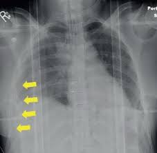 Image result for Flail Chest