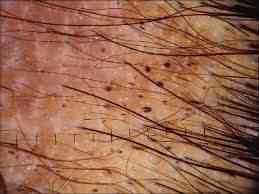 Histopathologically, they reveal stubs of hairs that are fractured before their emergence from the scalp. Black Dots And Short Vellus Hairs Download Scientific Diagram