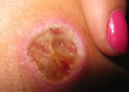 Image result for yellow sac spider bite skin