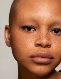 Image result for Freckled skin
