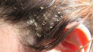 Fight Dandruff With These 5 Oils Naturallycurly Com