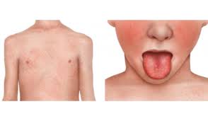 Image result for Scarlet Fever