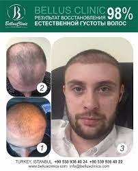 Hair Transplant Before After Hair Loss Hair Loss Women Hair Transplant Before And After