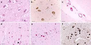 Studies of clearance rates of radiolabeled igg. Histopathological And Immunohistochemical Comparison Of The Brain Of Human Patients With Alzheimer S Disease And The Brain Of Aged Dogs With Cognitive Dysfunction Sciencedirect