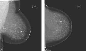 The idea of the screening programme is to use the usually if the mammogram finds a problem on screening, you will be sent an appointment with a specialist breast clinic. Detection Of Breast Cancer Screening Of Asymptomatic Patients Radiology Key