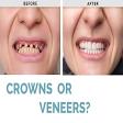 Dental Veneers/Laminates product image