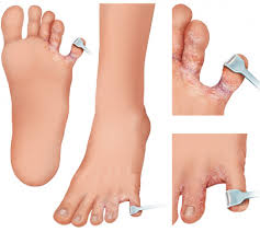 There are many things that may cause the skin on your feet to warm these oils slightly and rub them onto your feet. Cracked Skin Between Toes How To Treat Dryness Cuts Between Toes