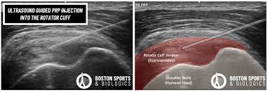 Image result for Biceps Tendon Injection