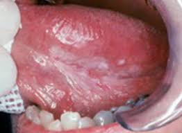 Image result for white cancer on tongue)