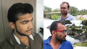 Balding In My 20 S In India Dealing With Balding As An Indian Man Youtube