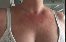 The Rash That Wouldn T Quit Kara Fitzgerald Nd Naturopathic Doctor