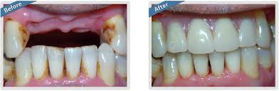 Rinse your dentures thoroughly with water. Before After Galstan Ward Family Cosmetic Dentistry