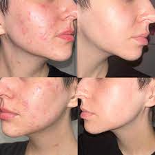 Skin Treatment 1