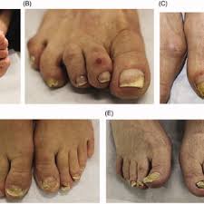 Image result for Pitting nails feet