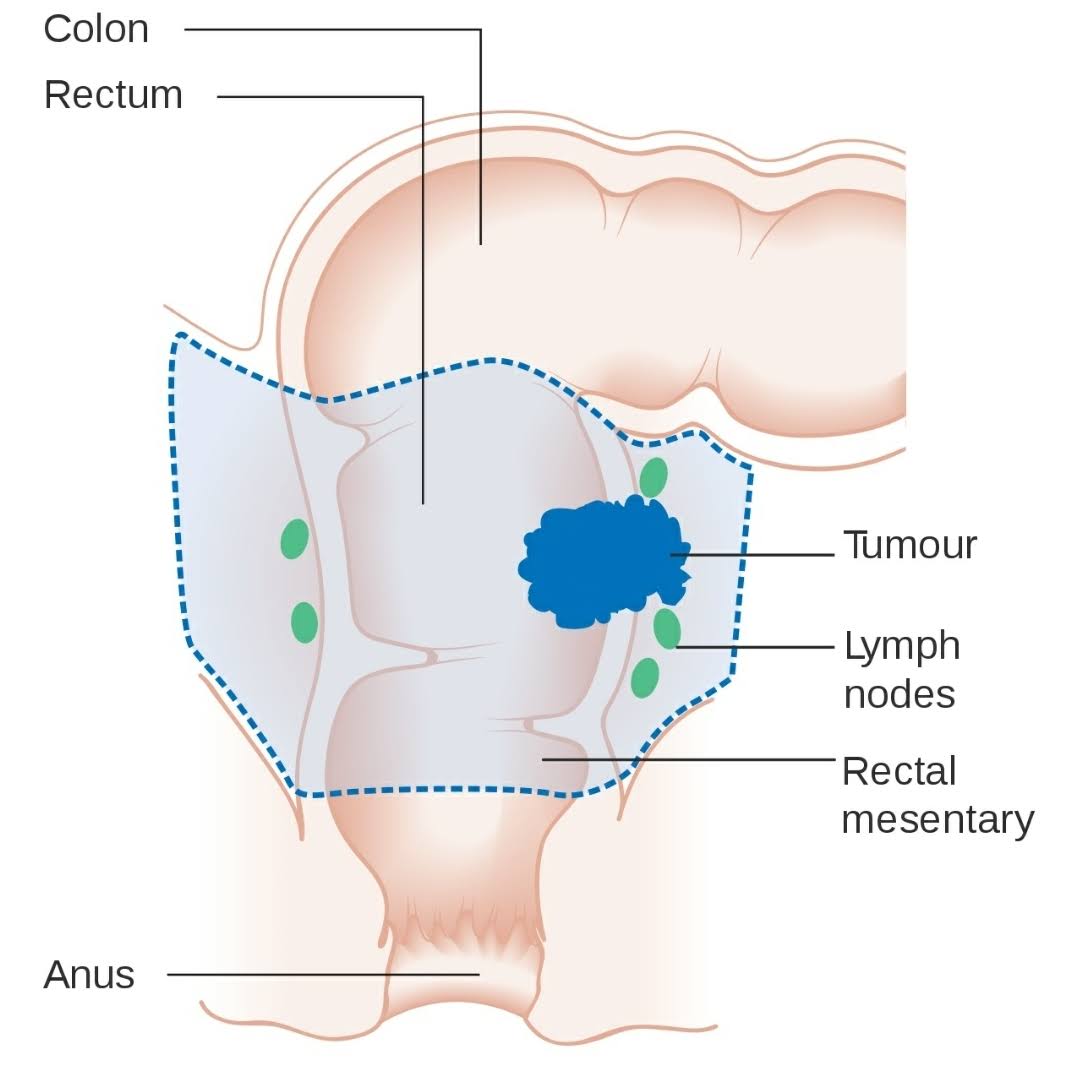 Colon and Rectal cancer treatment product image
