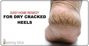 In this article, we look at the causes and treatment of dry, cracked, or scaly skin on the feet. Easy Home Remedy For Dry Cracked Heels Savory Lotus