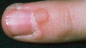 Check spelling or type a new query. Warts And Verrucas Causes And Treatments Bupa Uk
