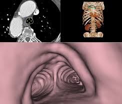 Image result for Virtual Endoscopy