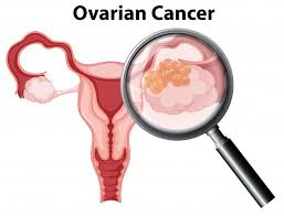 Her ovarian cancer recurred and spread quickly. Premium Vector Ovarian Cancer On White Background