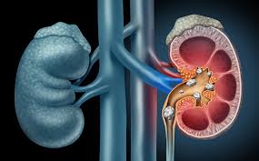 The kidneys are situated below the diaphragm, one on either side of the spine. Signs You May Have Kidney Stones Blog Loyola Medicine