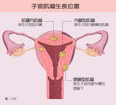 只要過了更年期 子宮肌瘤就會不見 婦科醫師這麼說 婦科 科別 元氣網 health story