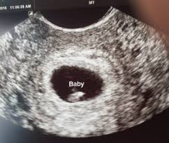 6 weeks pregnant belly pictures. Six Week Ultrasound 6 Weeks Pregnant Novocom Top