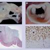 A tumor occurring in an unfavorable anatomic location that causes 2. Https Encrypted Tbn0 Gstatic Com Images Q Tbn And9gcspr Qft3 Ckwfhmsefge2as7b38 D Uwtj 1upkmtwec3jxzk8 Usqp Cau