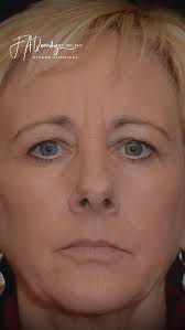 Brighter eyes. A refreshed expression. Natural results ✨ Shown here are  before and after photos just 2 months following an upper blepharoplasty and  brow lift performed by Dr. Dutton. These procedures work