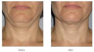 From fat to skinny neck. How To Get Rid Of A Fat Neck The Cosmetic Skin Clinic
