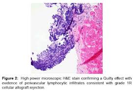 Microscopic study was compatible with acute myocarditis. De Novo Eosinophilic Myocarditis After Heart Transplantation Scitechnol