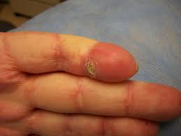 Educational image placeholder: skin thickening and tightening in systemic sclerosis