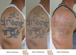 Tattoo Removal Is A Process This Client Started With Us 12 Months Ago And Is At The Point Where The Cover Up Proces Tattoo Removal Tattoos Tattoo Removal Cream