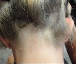 I noticed significant hair loss after going off birth control pills. Hair Loss At The Nape Of The Neck What Are The Main Causes Donovan Hair Clinic