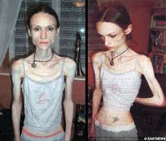 Resultado de imagen para anorexia