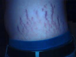 Dicke Fette Und Lange Rote Streifen An Meinem Bauch Hilfeeee Sport Abnehmen Rot