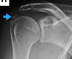 Image result for Rotator Cuff Calcification
