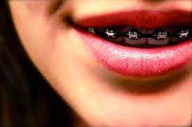 O discusses how long braces should take in this edition of the friday focuse&s orthodontics is a leading provider of damon braces and invisalign in phoen. How Long Does It Take To Get Braces Will It Hurt