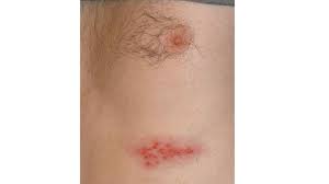 El herpes zoster es una dolorosa erupción cutánea que típicamente afecta una mitad del cuerpo o de la cara y que es conocido popularmente en algunos países de latinoamérica como culebrilla. Presentaron La Primera Vacuna Contra La Culebrilla Salud La Voz Del Interior