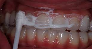 Eliminer Le Tartre Et Blanchir Les Dents En 4 Etapes Blanchir Les Dents Avoir Les Dents Blanches Detartrer Dents