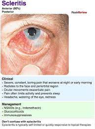 Scleritis Family Nurse Practitioner Eye Health Nurse Practitioner