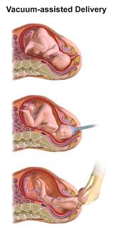 Image result for Forceps Assisted Delivery