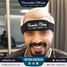 زراعة الشعر هي الحل النهائي لـ علاج الشعر الخفيف علاج الصلع الوراثي و تساقط الشعر المزمن في كاميليا كلينك نستخدم أحدث التقنيات الـ dhi الاترا سيلت ا