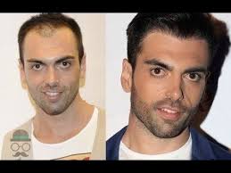 The Cost Of Hair Transplant In Saudi Arabia And Tahm Hair Transplant Techniques Used The Cost Of Hair Transplant In Saudi Arabia Hair Transplant Hair Beauty