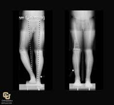 Image result for Genu Varum