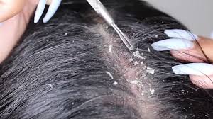 You are the first person i've ever told about this. If You Re Thinking Of Scraping Your Dandruff For Likes Please Don T Bbc Three